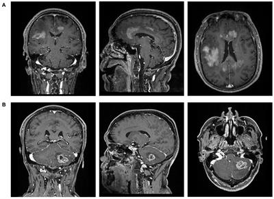 Comparison of Radiomics-Based Machine-Learning Classifiers in Diagnosis of Glioblastoma From Primary Central Nervous System Lymphoma